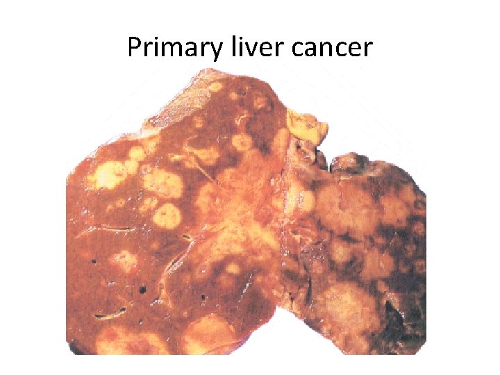 Primary liver cancer 