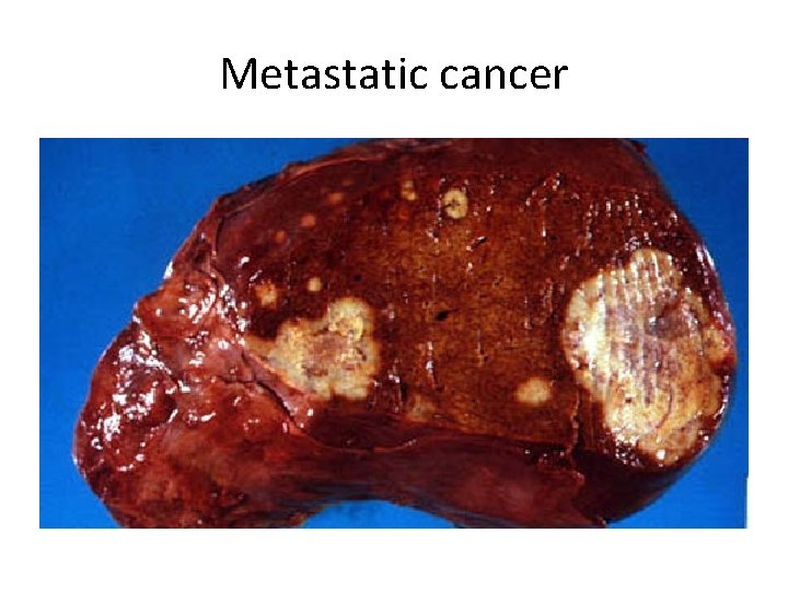 Metastatic cancer 