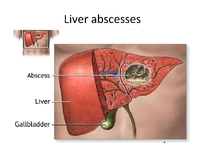Liver abscesses 
