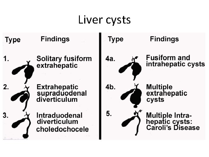 Liver cysts 