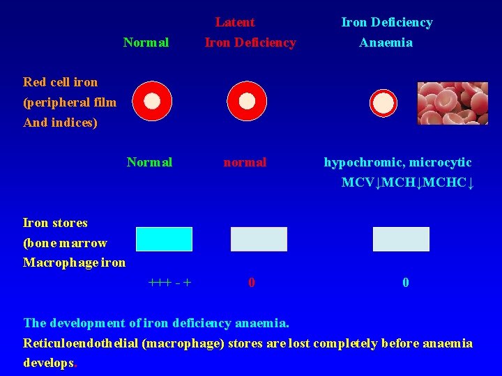 Normal Latent Iron Deficiency Anaemia Red cell iron (peripheral film And indices) Normal normal