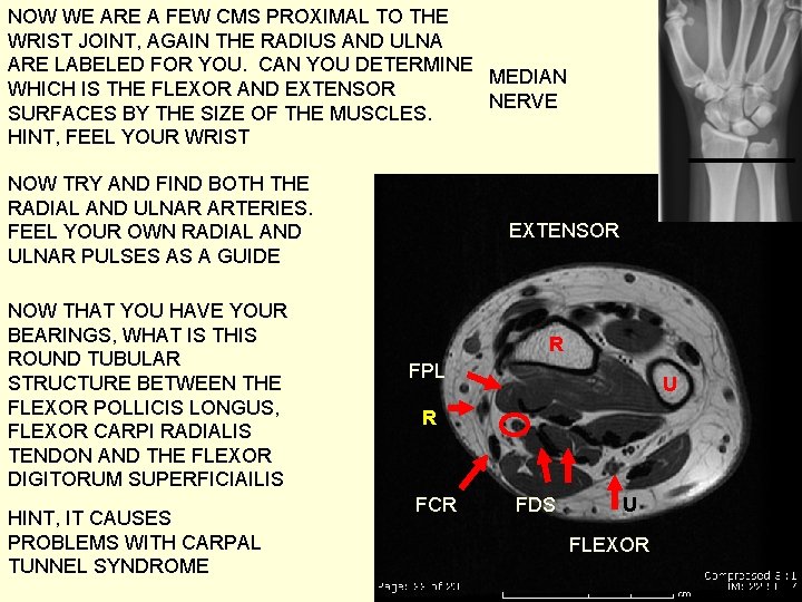 NOW WE ARE A FEW CMS PROXIMAL TO THE WRIST JOINT, AGAIN THE RADIUS