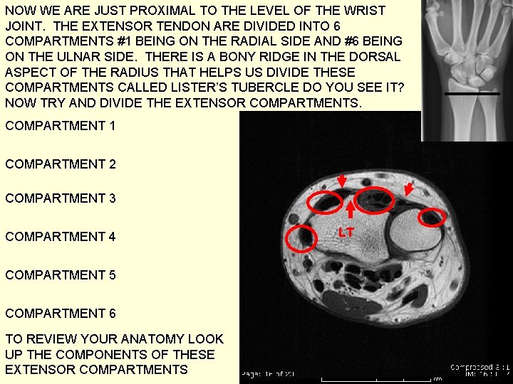 NOW WE ARE JUST PROXIMAL TO THE LEVEL OF THE WRIST JOINT. THE EXTENSOR