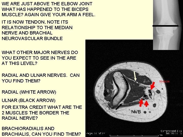 WE ARE JUST ABOVE THE ELBOW JOINT WHAT HAS HAPPENED TO THE BICEPS MUSCLE?