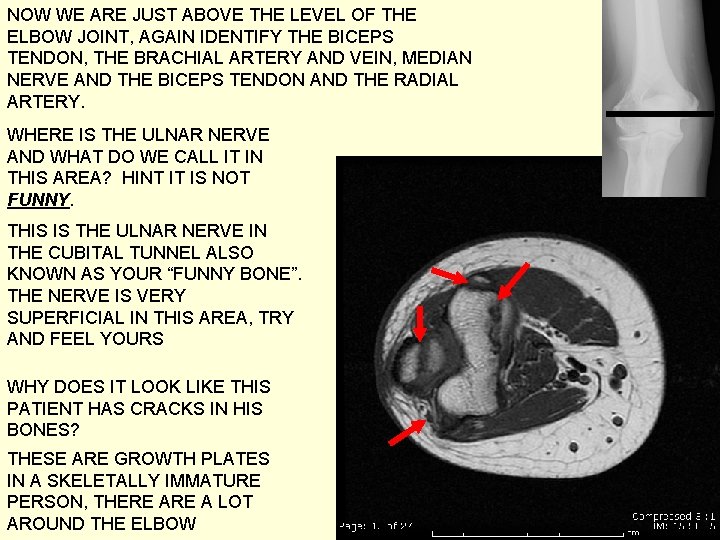 NOW WE ARE JUST ABOVE THE LEVEL OF THE ELBOW JOINT, AGAIN IDENTIFY THE