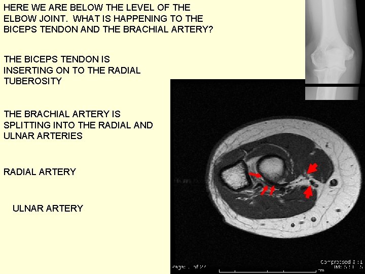 HERE WE ARE BELOW THE LEVEL OF THE ELBOW JOINT. WHAT IS HAPPENING TO