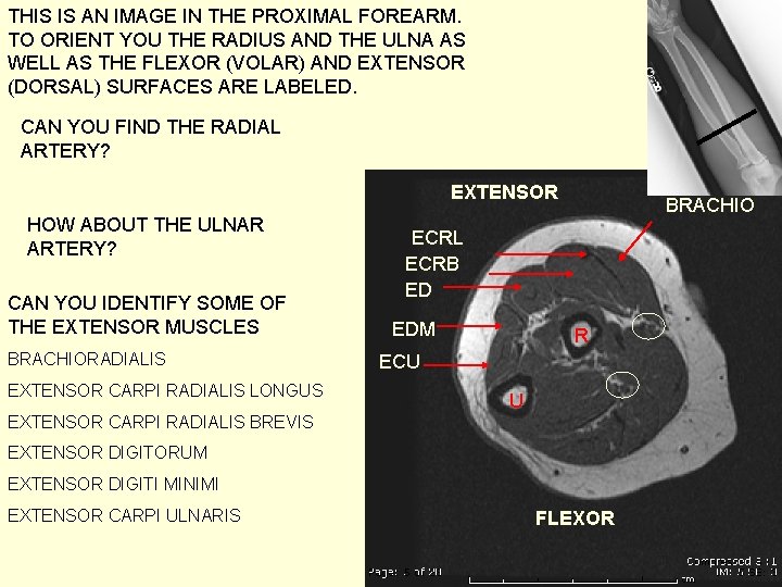 THIS IS AN IMAGE IN THE PROXIMAL FOREARM. TO ORIENT YOU THE RADIUS AND
