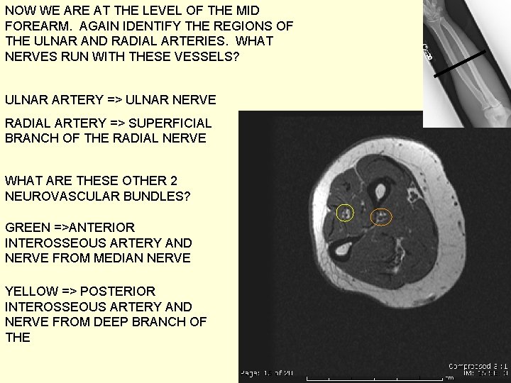 NOW WE ARE AT THE LEVEL OF THE MID FOREARM. AGAIN IDENTIFY THE REGIONS