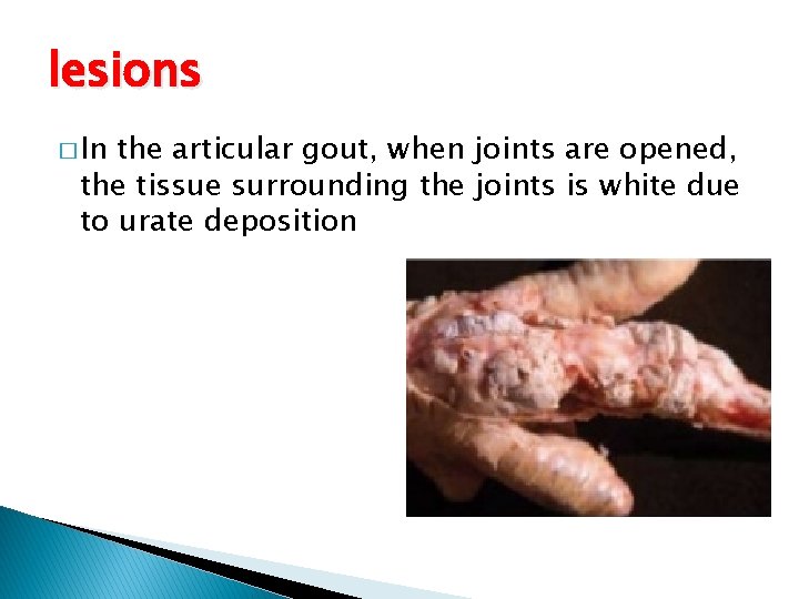 lesions � In the articular gout, when joints are opened, the tissue surrounding the