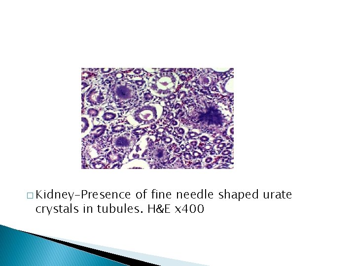 � Kidney-Presence of fine needle shaped urate crystals in tubules. H&E x 400 