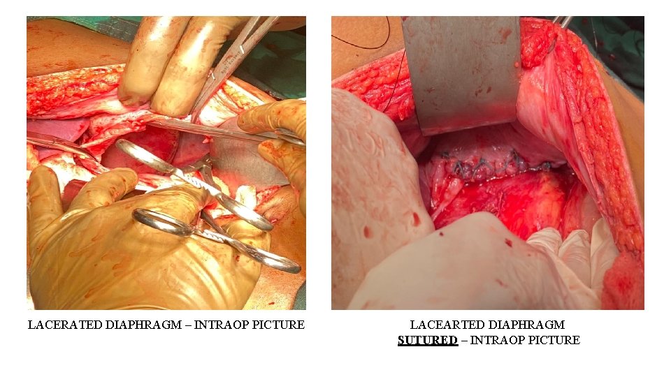 LACERATED DIAPHRAGM – INTRAOP PICTURE LACEARTED DIAPHRAGM SUTURED – INTRAOP PICTURE 