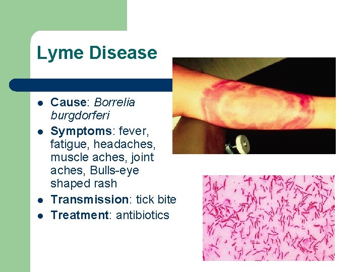 Lyme Disease l l Cause: Borrelia burgdorferi Symptoms: fever, fatigue, headaches, muscle aches, joint