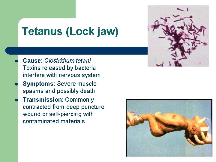 Tetanus (Lock jaw) l l l Cause: Clostridium tetani Toxins released by bacteria interfere