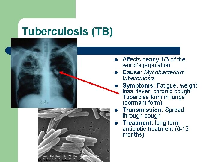 Tuberculosis (TB) l l l Affects nearly 1/3 of the world’s population Cause: Mycobacterium