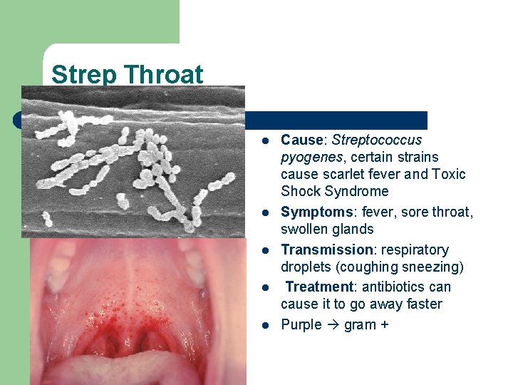 Strep Throat l l l Cause: Streptococcus pyogenes, certain strains cause scarlet fever and