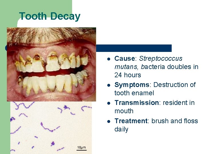 Tooth Decay l l Cause: Streptococcus mutans, bacteria doubles in 24 hours Symptoms: Destruction