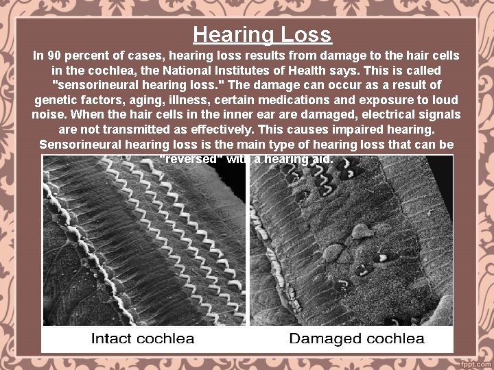 Hearing Loss In 90 percent of cases, hearing loss results from damage to the