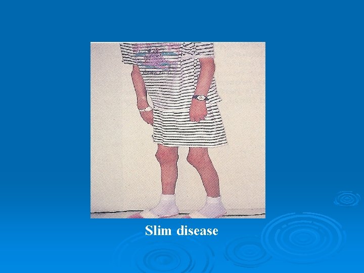 Slim disease 