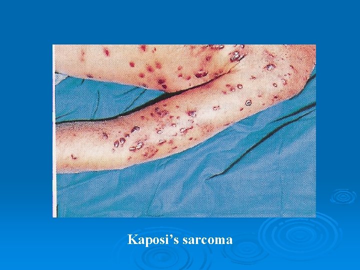 Kaposi’s sarcoma 