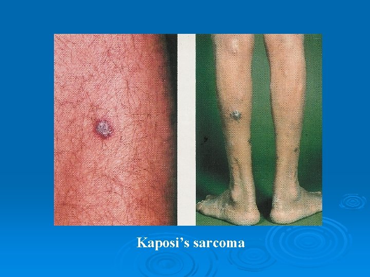 Kaposi’s sarcoma 