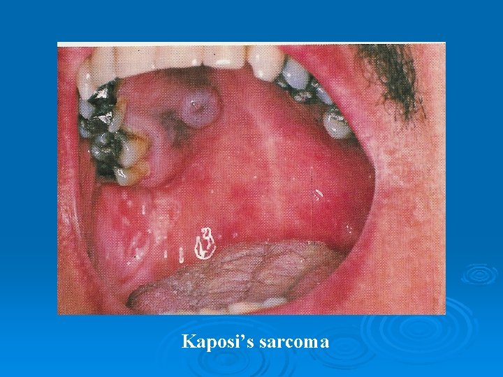 Kaposi’s sarcoma 