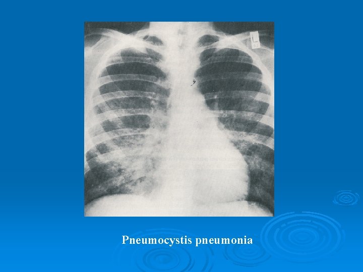 Pneumocystis pneumonia 