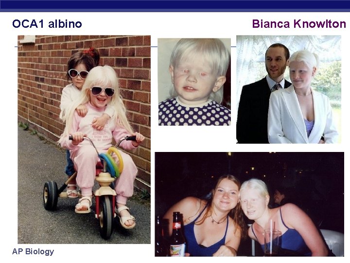 OCA 1 albino AP Biology Bianca Knowlton 