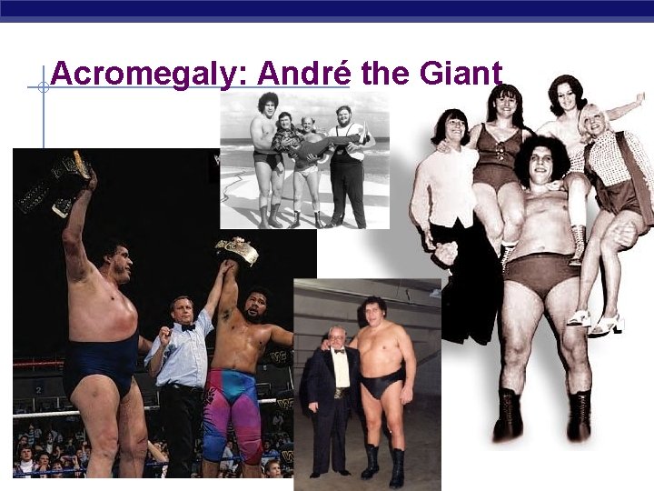 Acromegaly: André the Giant AP Biology 