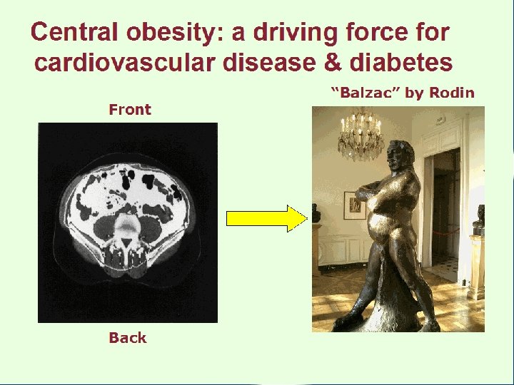 Central obesity: a driving force for cardiovascular disease & diabetes Front Back “Balzac” by