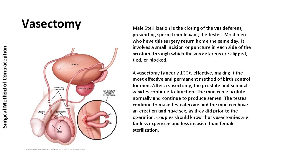 Surgical Method of Contraception Vasectomy Male Sterilization is the closing of the vas deferens,