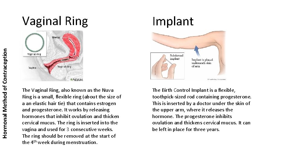 Hormonal Method of Contraception Vaginal Ring Implant The Vaginal Ring, also known as the