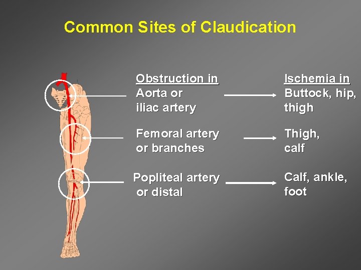 Common Sites of Claudication Obstruction in Aorta or iliac artery Ischemia in Buttock, hip,
