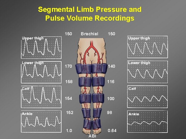 Segmental Limb Pressure and Pulse Volume Recordings 150 Brachial 150 170 140 158 116