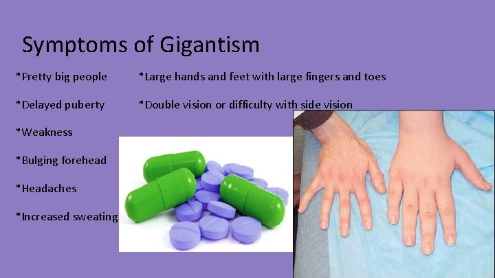 Symptoms of Gigantism *Pretty big people *Large hands and feet with large fingers and