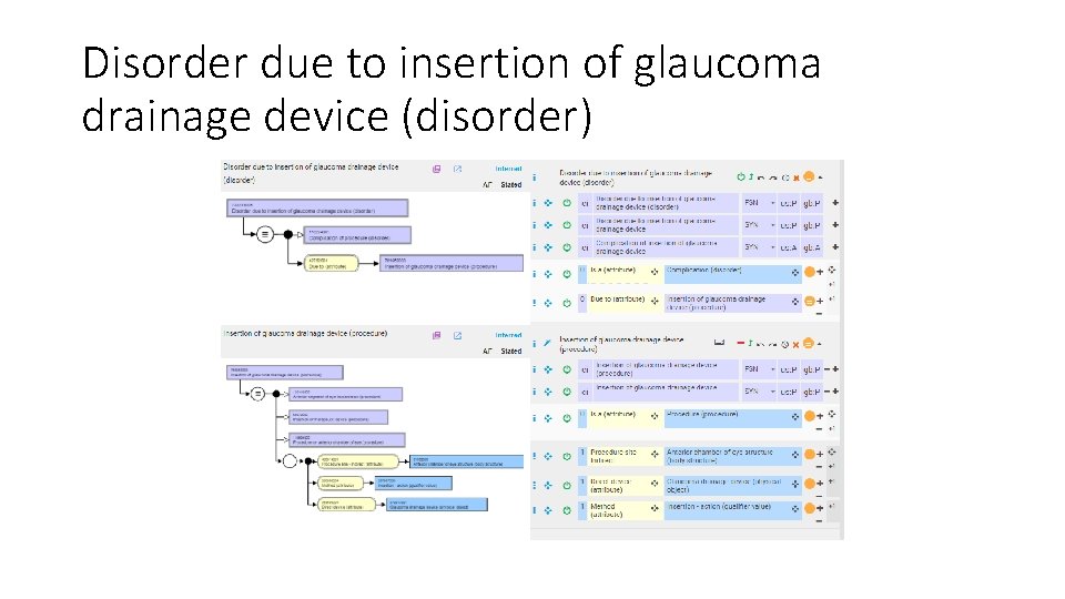 Disorder due to insertion of glaucoma drainage device (disorder) 