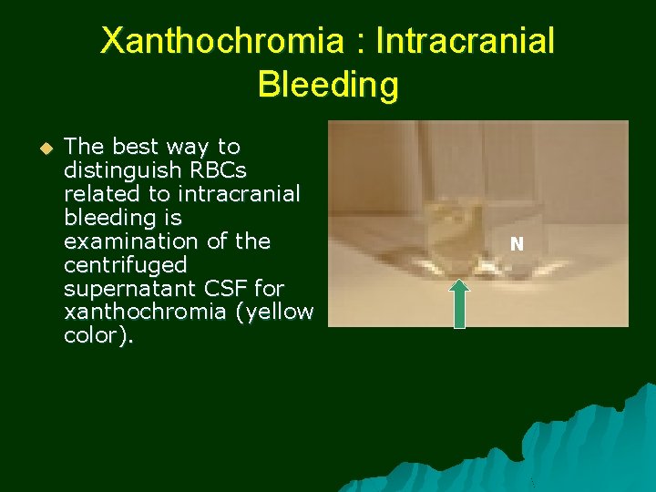 Xanthochromia : Intracranial Bleeding u The best way to distinguish RBCs related to intracranial