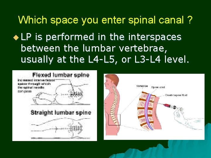Which space you enter spinal canal ? u LP is performed in the interspaces
