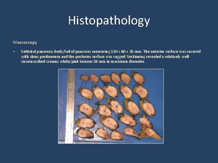 Histopathology Macroscopy • Subtotal pancreas; body/tail of pancreas measuring 130 x 60 x 35