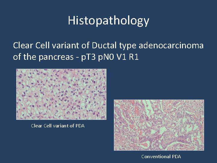 Histopathology Clear Cell variant of Ductal type adenocarcinoma of the pancreas - p. T