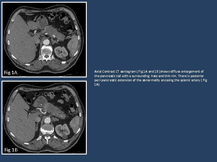 Fig 1 A Fig 1 B Axial Contrast CT aortogram ( Fig 1 A