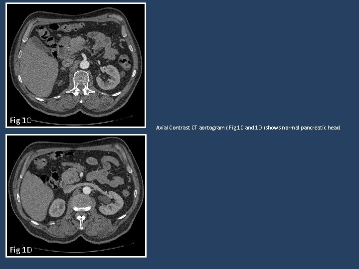 Fig 1 C Fig 1 D Axial Contrast CT aortogram ( Fig 1 C