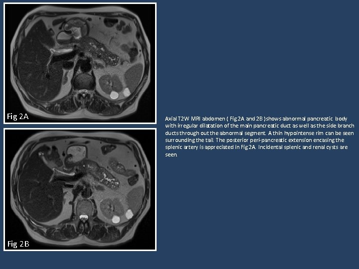 Fig 2 A Fig 2 B Axial T 2 W MRI abdomen ( Fig