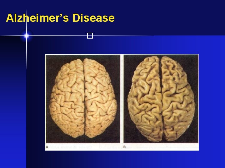 Alzheimer’s Disease � 