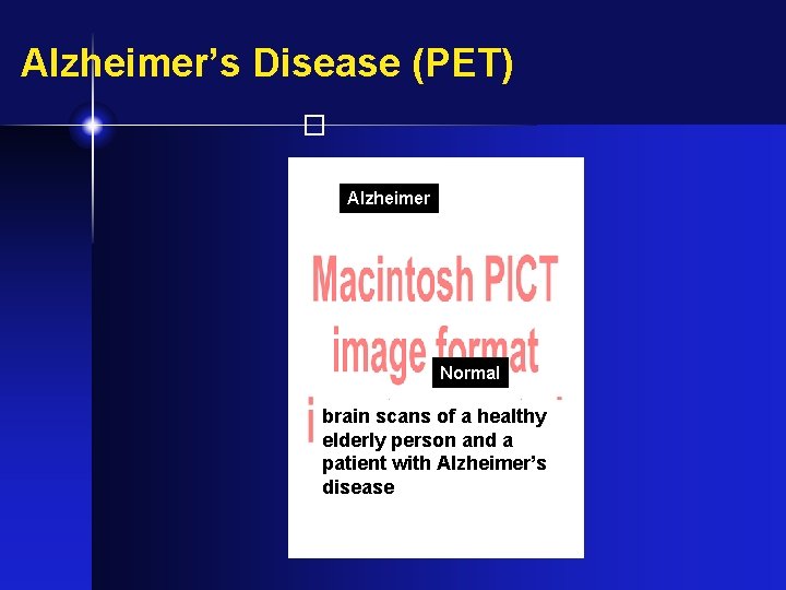 Alzheimer’s Disease (PET) � Alzheimer Normal brain scans of a healthy elderly person and