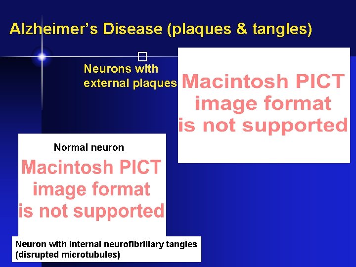 Alzheimer’s Disease (plaques & tangles) � Neurons with external plaques Normal neuron Neuron with