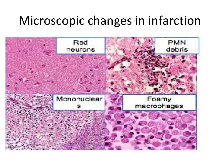 Microscopic changes in infarction 