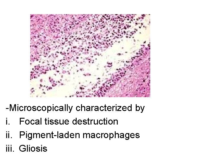 -Microscopically characterized by i. Focal tissue destruction ii. Pigment-laden macrophages iii. Gliosis 