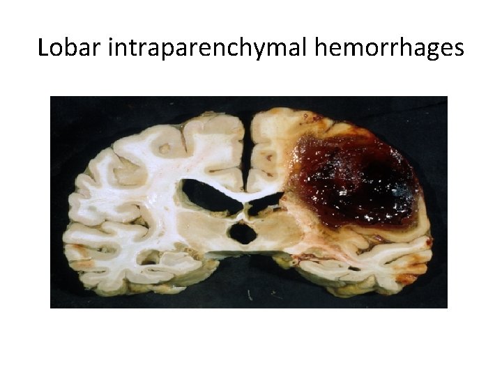 Lobar intraparenchymal hemorrhages 