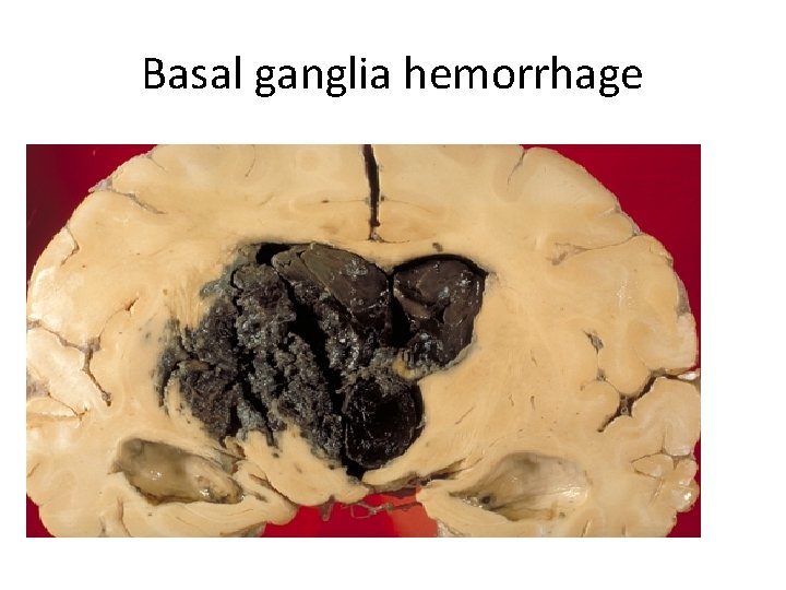Basal ganglia hemorrhage 