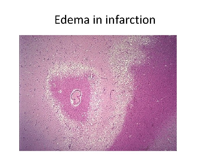 Edema in infarction 